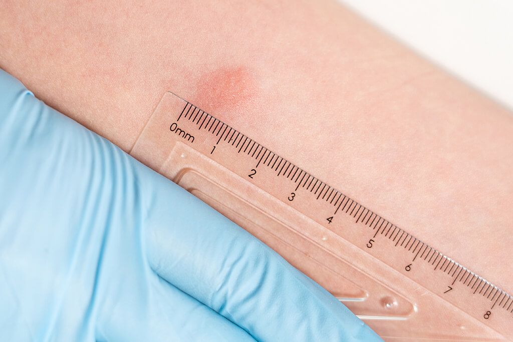 TB Testing | New York TB Testing | Mobile Health | TB Tests